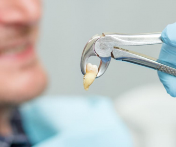 Простое удаление зуба (в том числе анестезия и консультация)