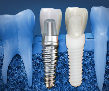 Имплантация